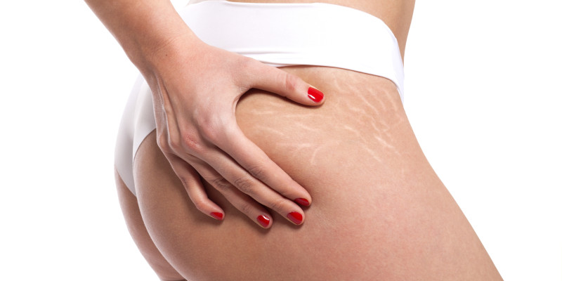 Foto: Removal of stretch marks